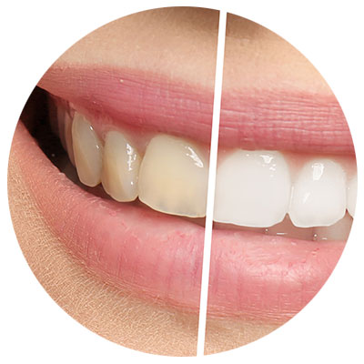 tooth-whitening westminster