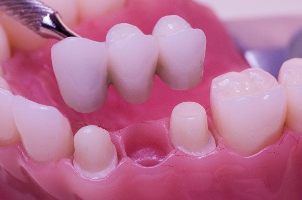 dental bridge westminster