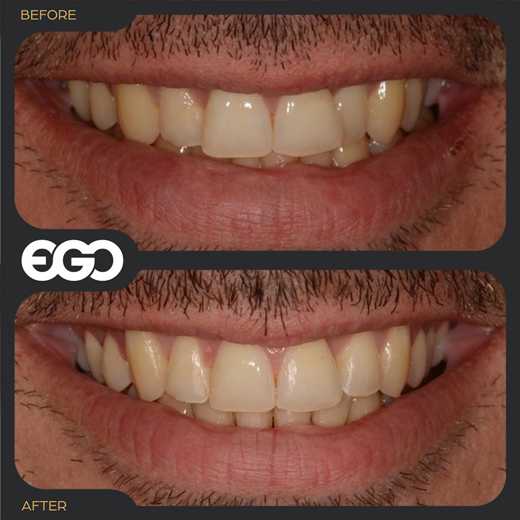 Invisalign london