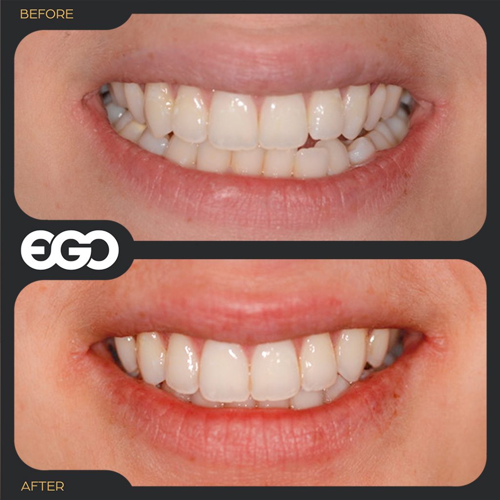 Invisalign london