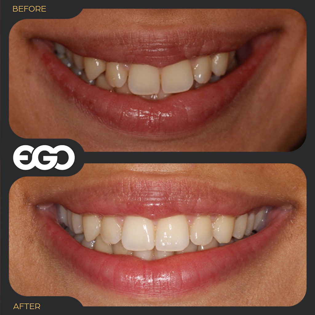 Invisalign london