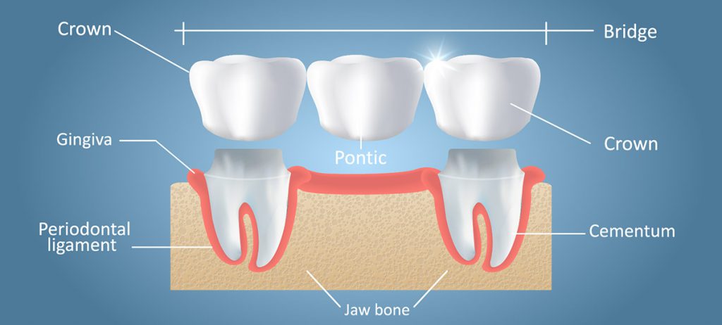 Dental-Bridge