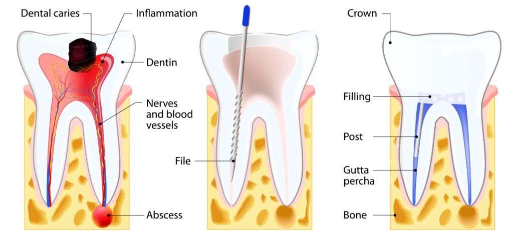 Dental Fillings at Dental Clinic & Dental Practice in Victoria &  Westminster London SW1