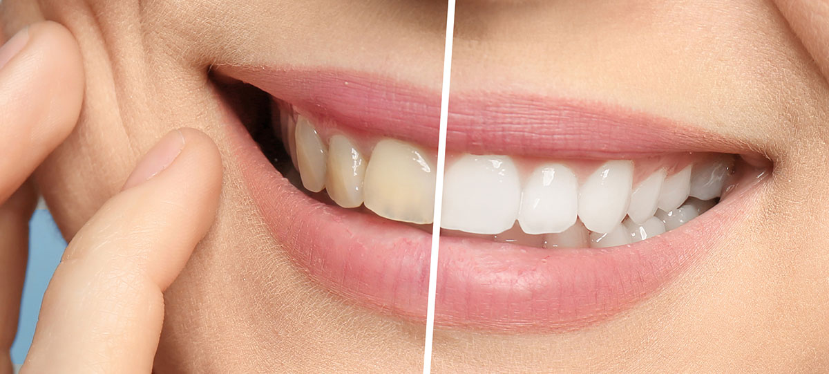 Tooth-Whitening-westminster