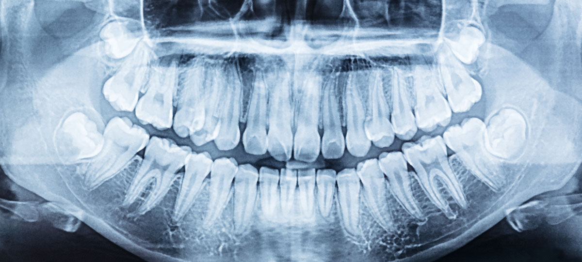 Wisdom-tooth-Extraction