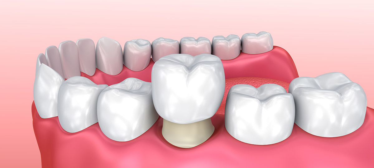 dental-crown-westminster