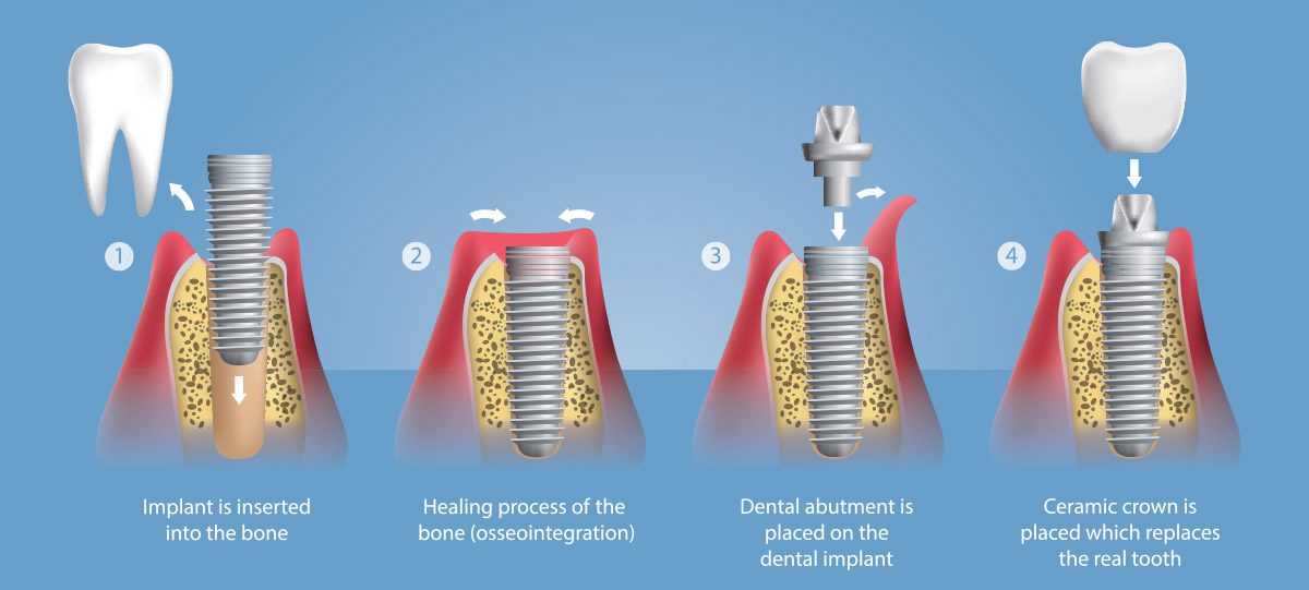 implants-dentistry-london