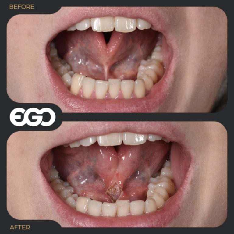 Laser Frenectomy The Official EGO Dental Clinic Westminster
