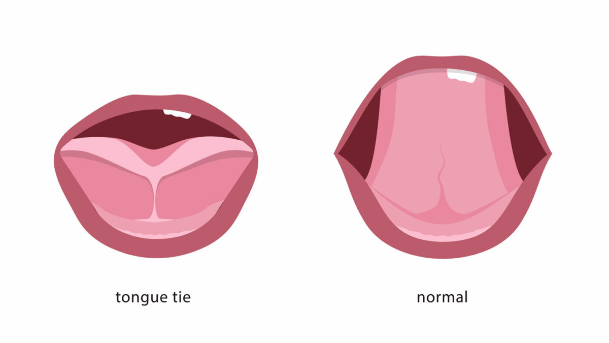 Laser-Frenectomy