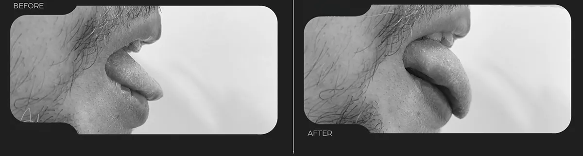 Laser-Frenectomy-london-sw1