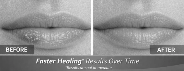 cold-sore laser treatment