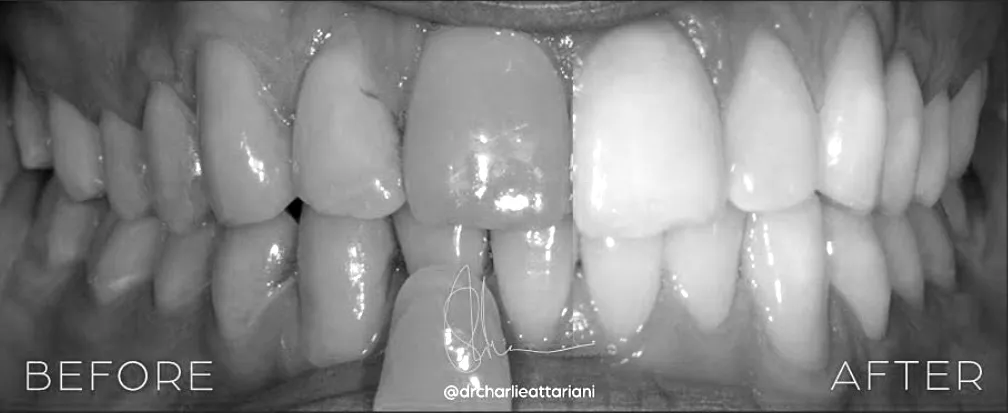 professional teeth whitening