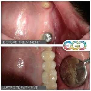 Dental Bridge BEFORE/AFTER PHOTO - EGO DENTAL LONDON SW1