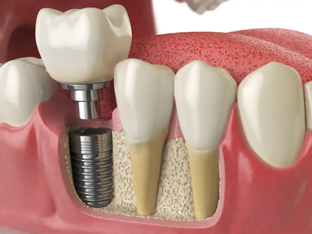 Dental Implants in Modern Dentistry: The  Guide to Replacing Missing Teeth