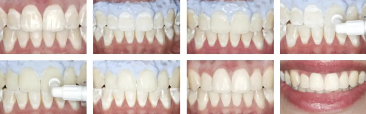 ICON - White Spots Removal London Victoria